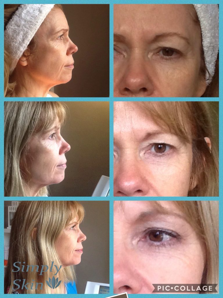 CACI non-surgical face and eye lift